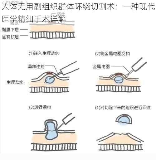 人体无用副组织群体环绕切割术：一种现代医学精细手术详解